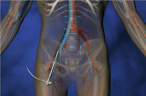 CardioMEMS HF??????????????????