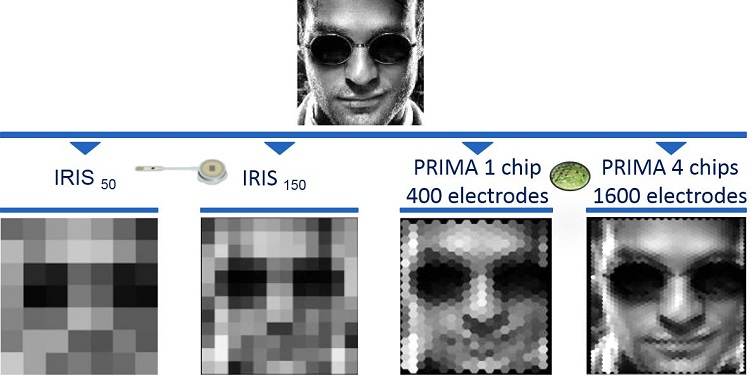 Pixium Vision??????????????????????????