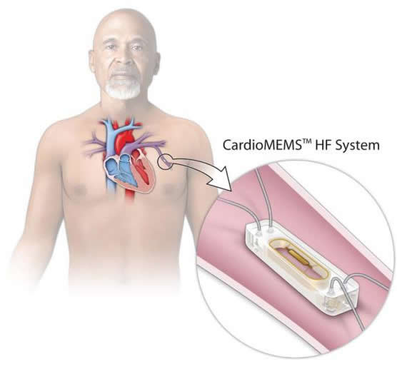 ?о???????????CardioMEMS??????????????????????44%