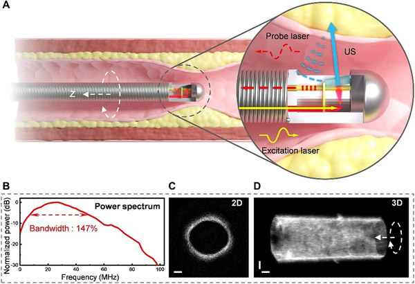 ???????AO-IVUS??????